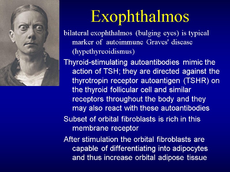 Exophthalmos bilateral exophthalmos (bulging eyes) is typical marker of  autoimmune Graves' disease 